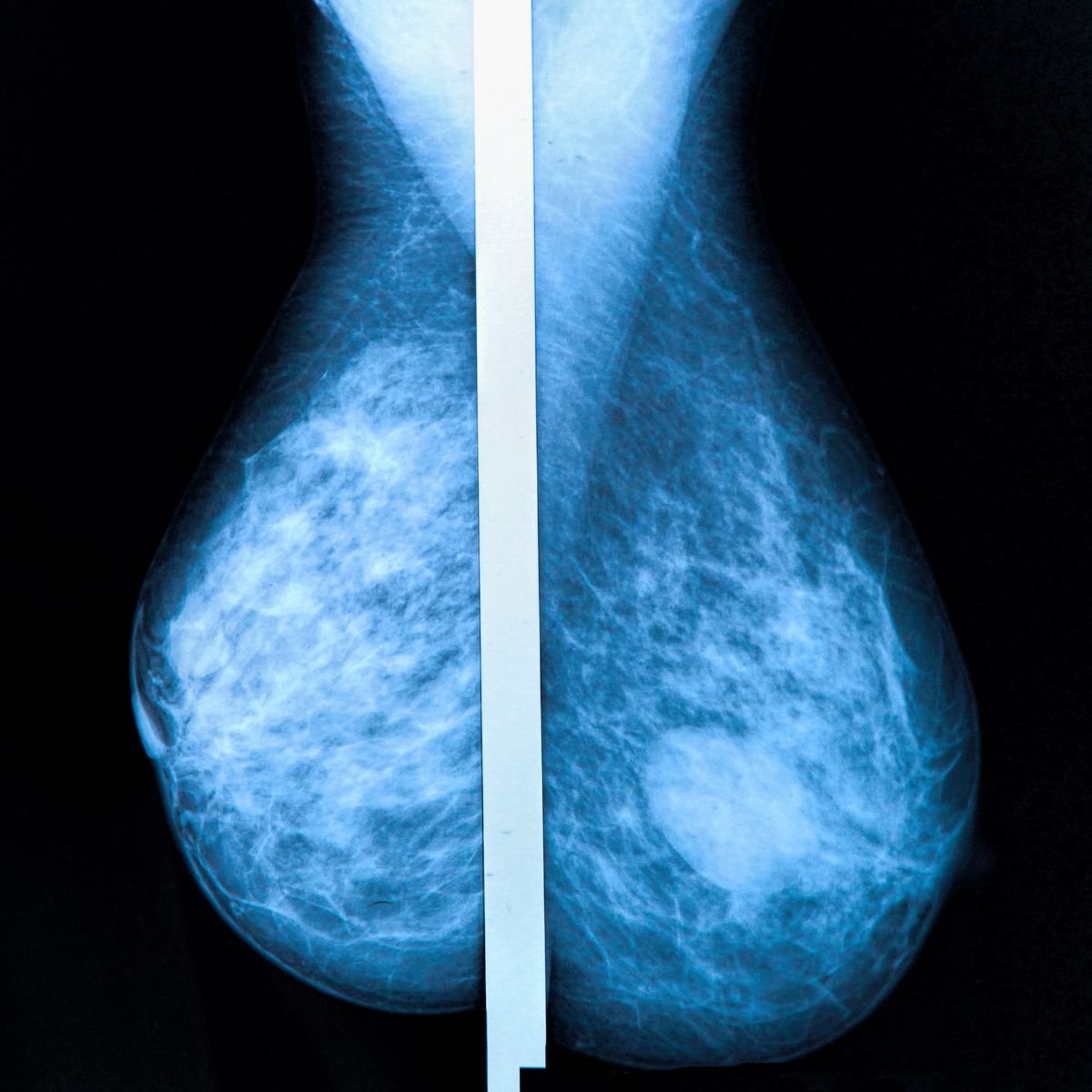 Digital mammography film used for OBSP breast cancer screening