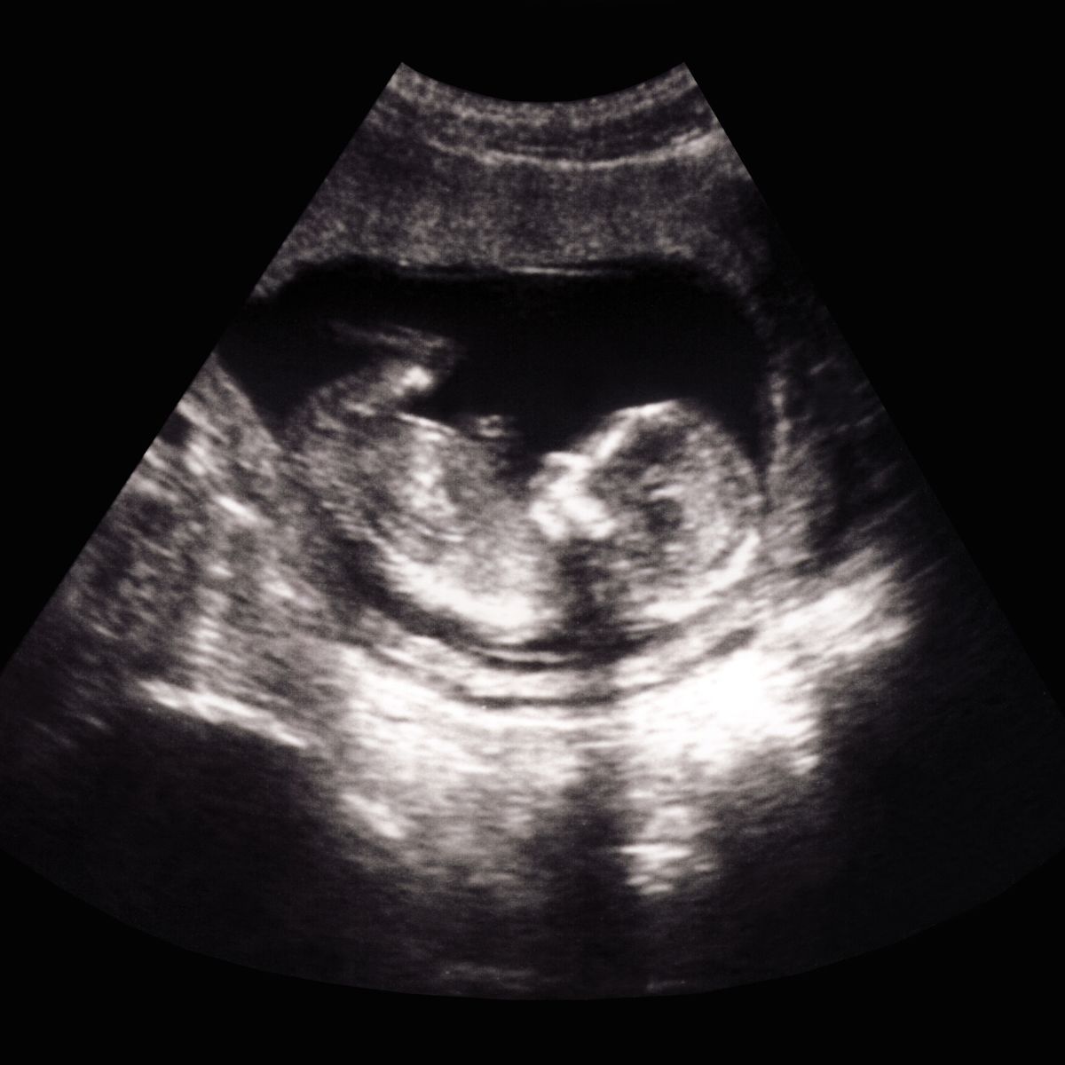 Obstetric ultrasound scan image at Annex Medical Imaging